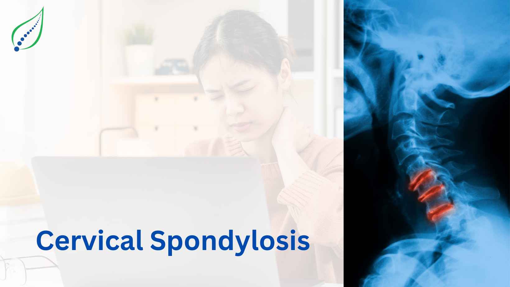 Cervical Spondylosis